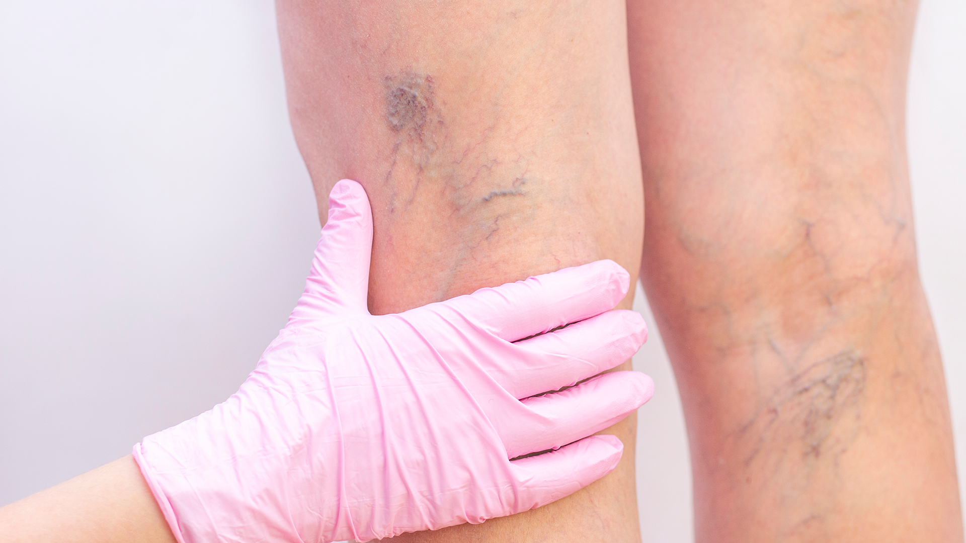 Médica angiologista examina varizes em perna de paciente